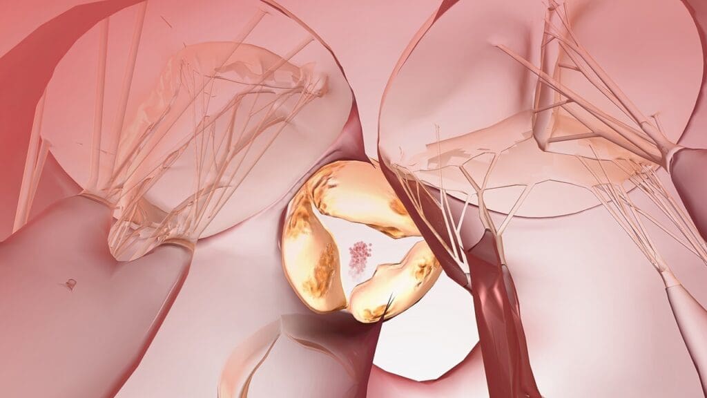 age-related heart valve calcification age-related heart valve calcification