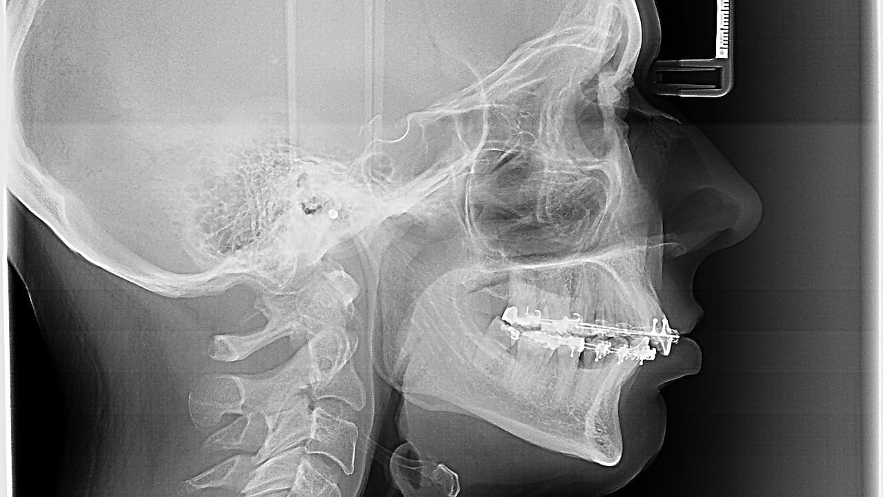 7 Key Facts About Anterior Cervical Discectomy and Fusion (ACDF) Spine Surgery