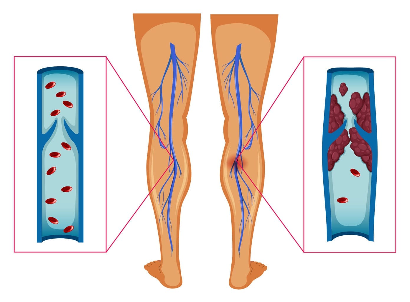 7 Key Leg Aneurysm Symptoms: How to Recognize and Respond Quickly