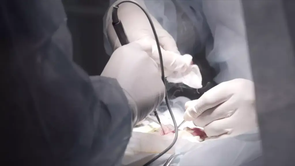 7 Key Facts About Ascending Aortic Aneurysm Surgery and Treatment