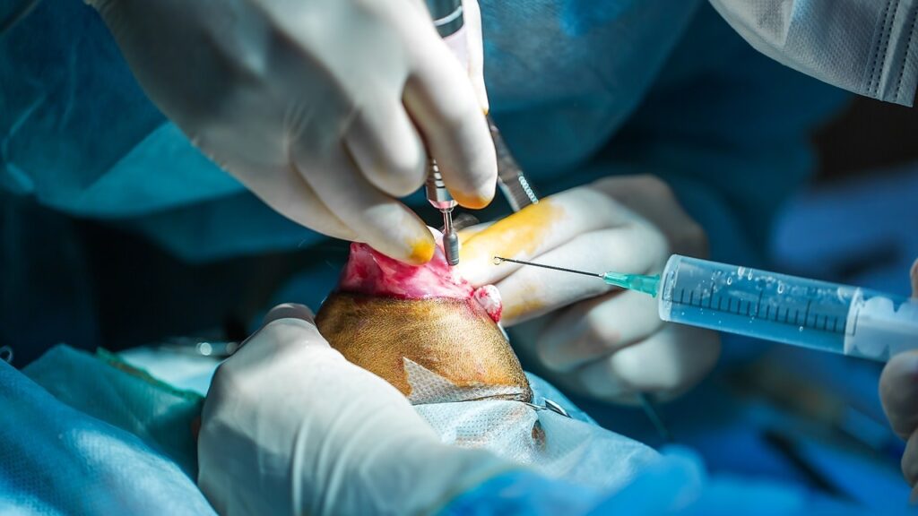 autograft bone graft autograft bone graft