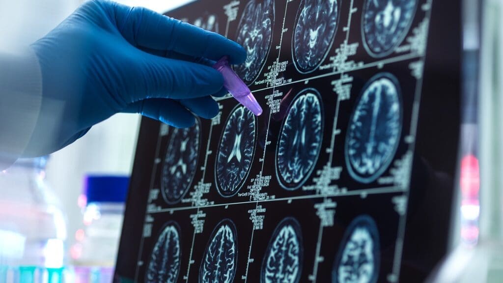 Before and After Brain Surgery: 10 Key Insights for Recovery and Expectations