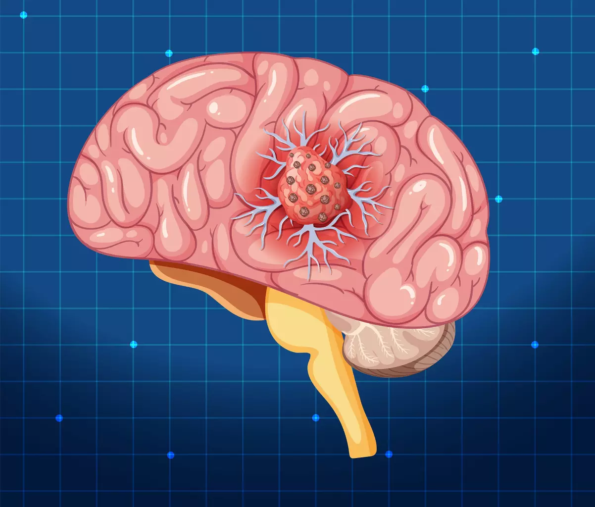 Benign Brain Tumor Symptoms: 10 Key Signs and What to Watch For