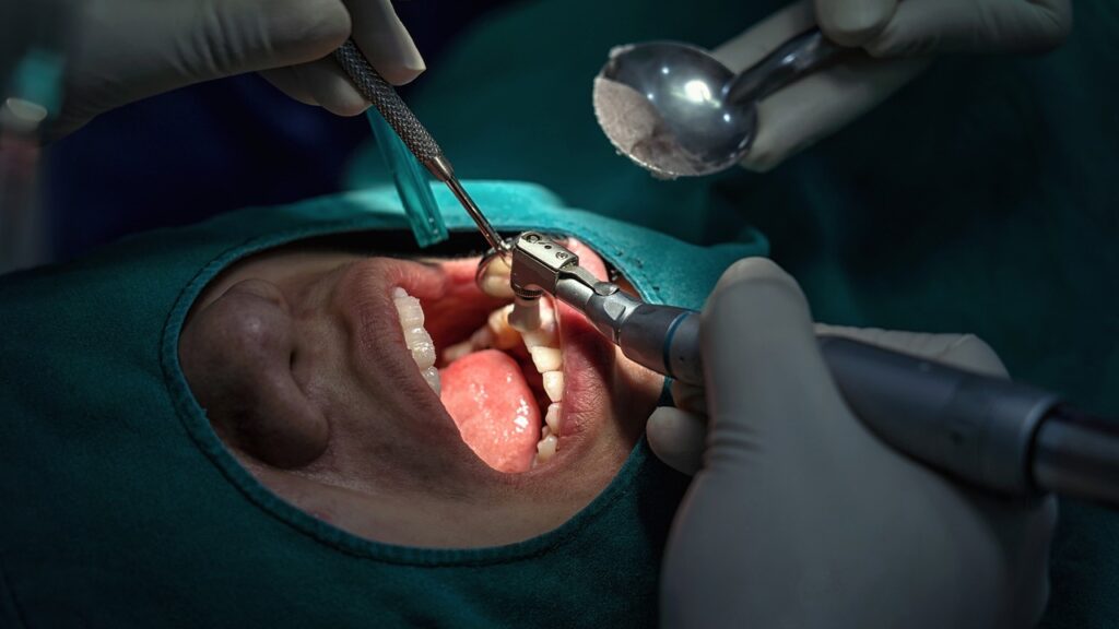 bone graft mouth