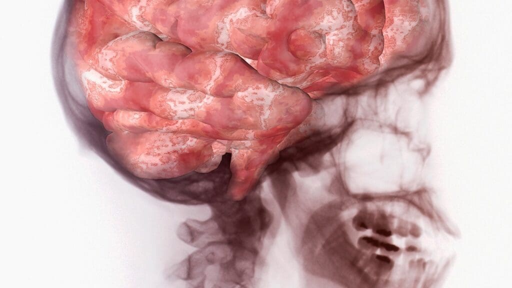 brain inflammation brain inflammation