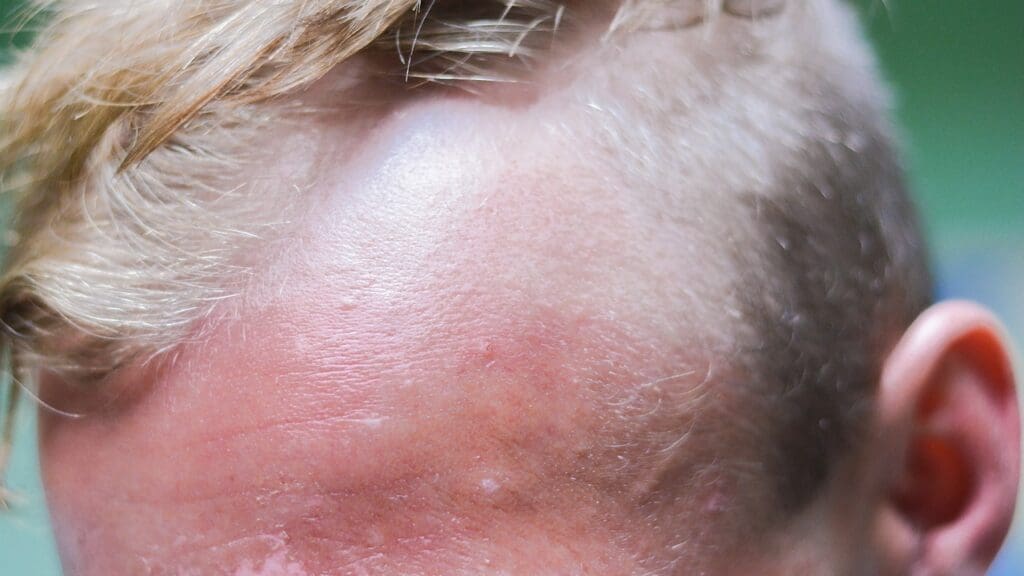 11 Key Brain Tumor Rash and Symptom Signs to Watch For
