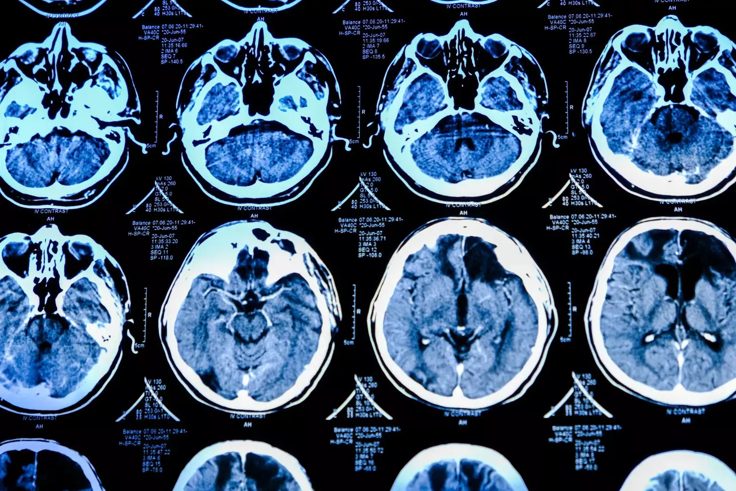 How Are Brain Tumor Stages Classified and What Is the Prognosis for Stage 2 Brain Cancer?