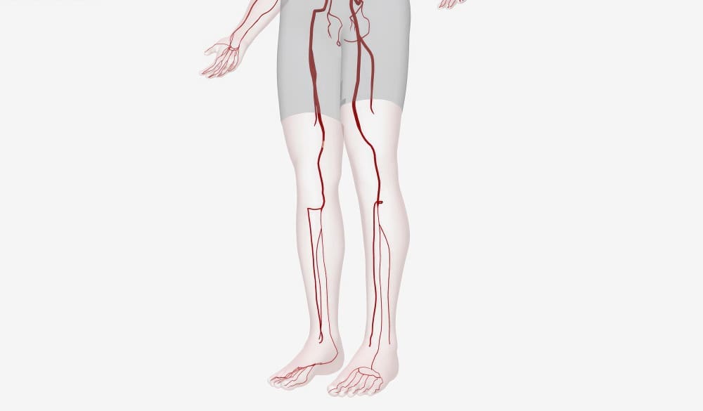 7 Key Facts About Popliteal Artery Aneurysm Symptoms and Treatment