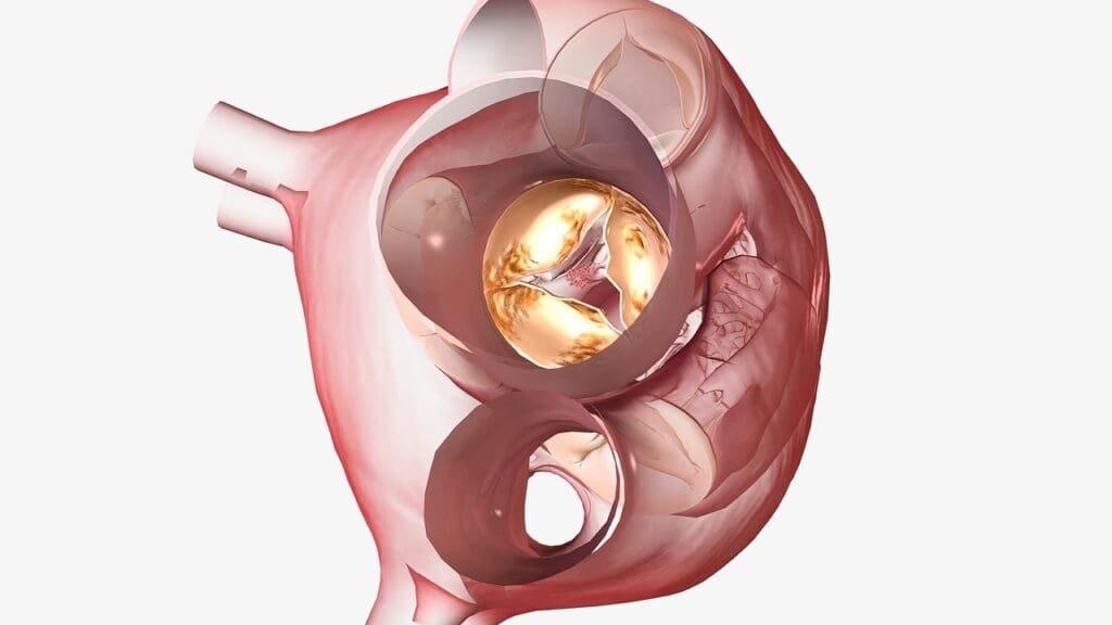 calcified heart valve