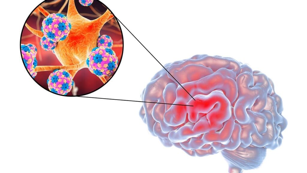 causes of fluid buildup in the brain causes of fluid buildup in the brain
