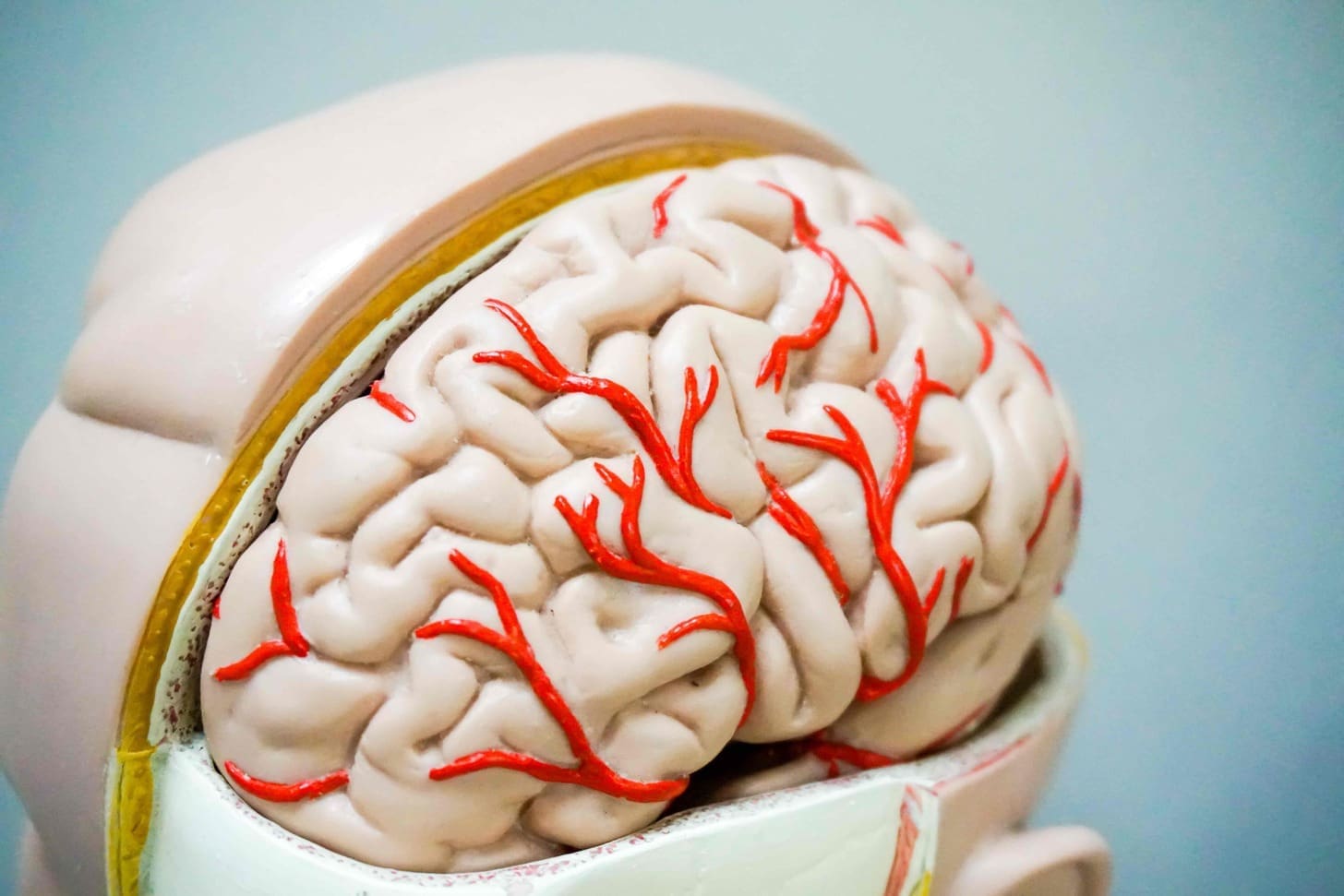 Cerebral Vascular Malformation: 7 Key Facts on AVM, Rupture, and Treatment