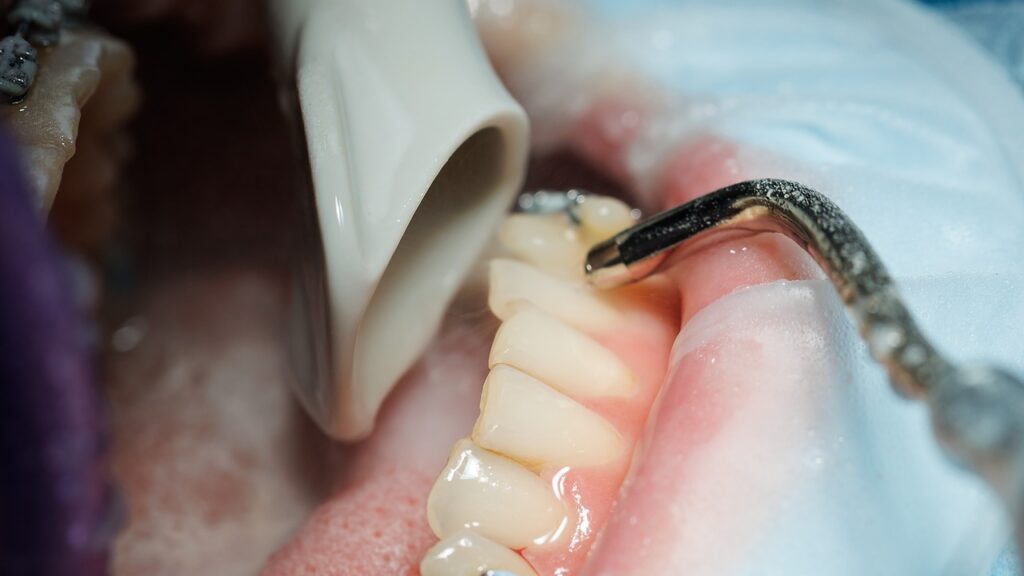 dental bone graft procedure dental bone graft procedure