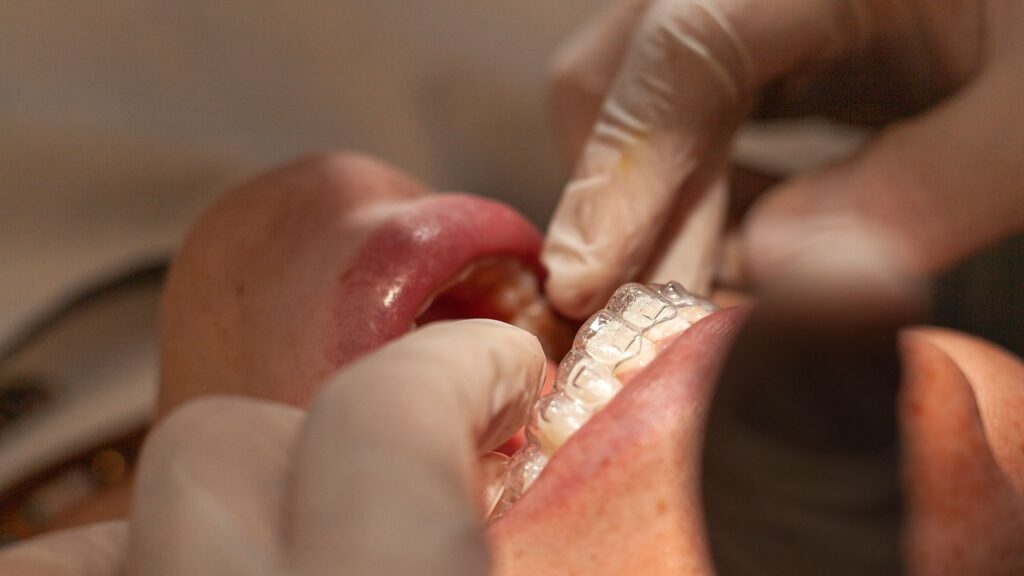 dental bone graft procedure dental bone graft procedure