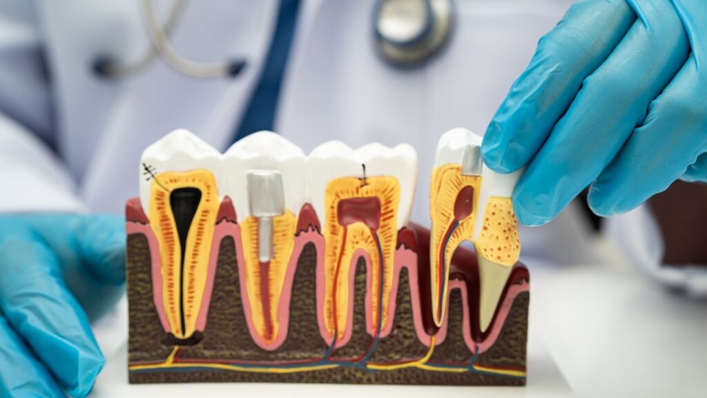 dental bone loss dental bone loss