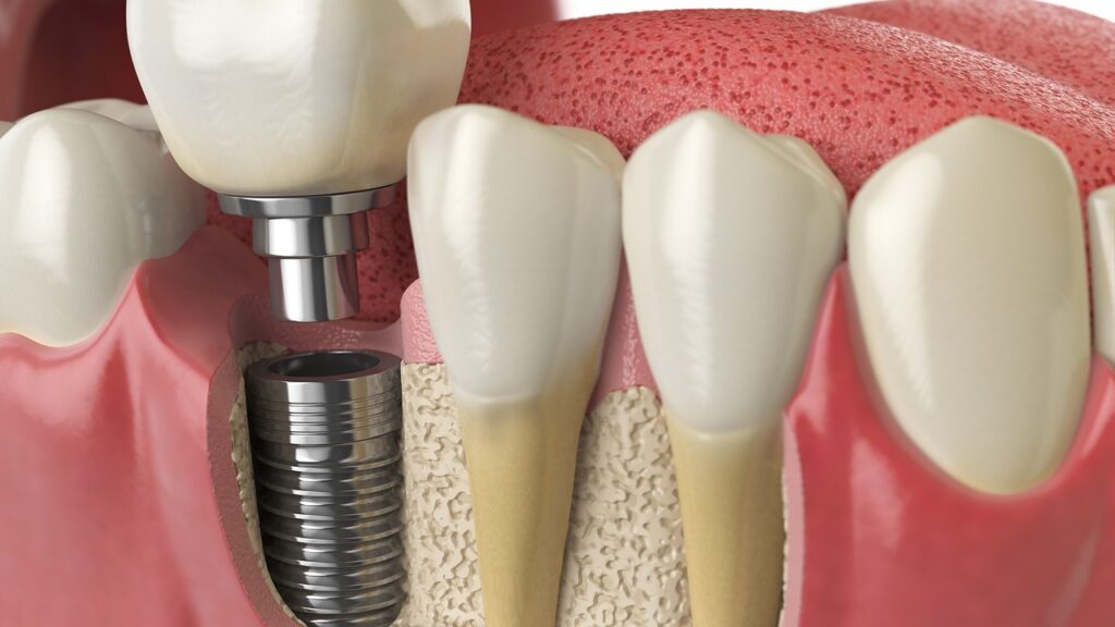 dental implant bone graft dental implant bone graft