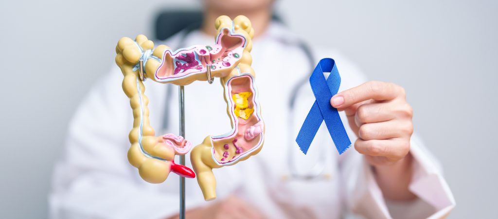 Can colon cancer be cured permanently?