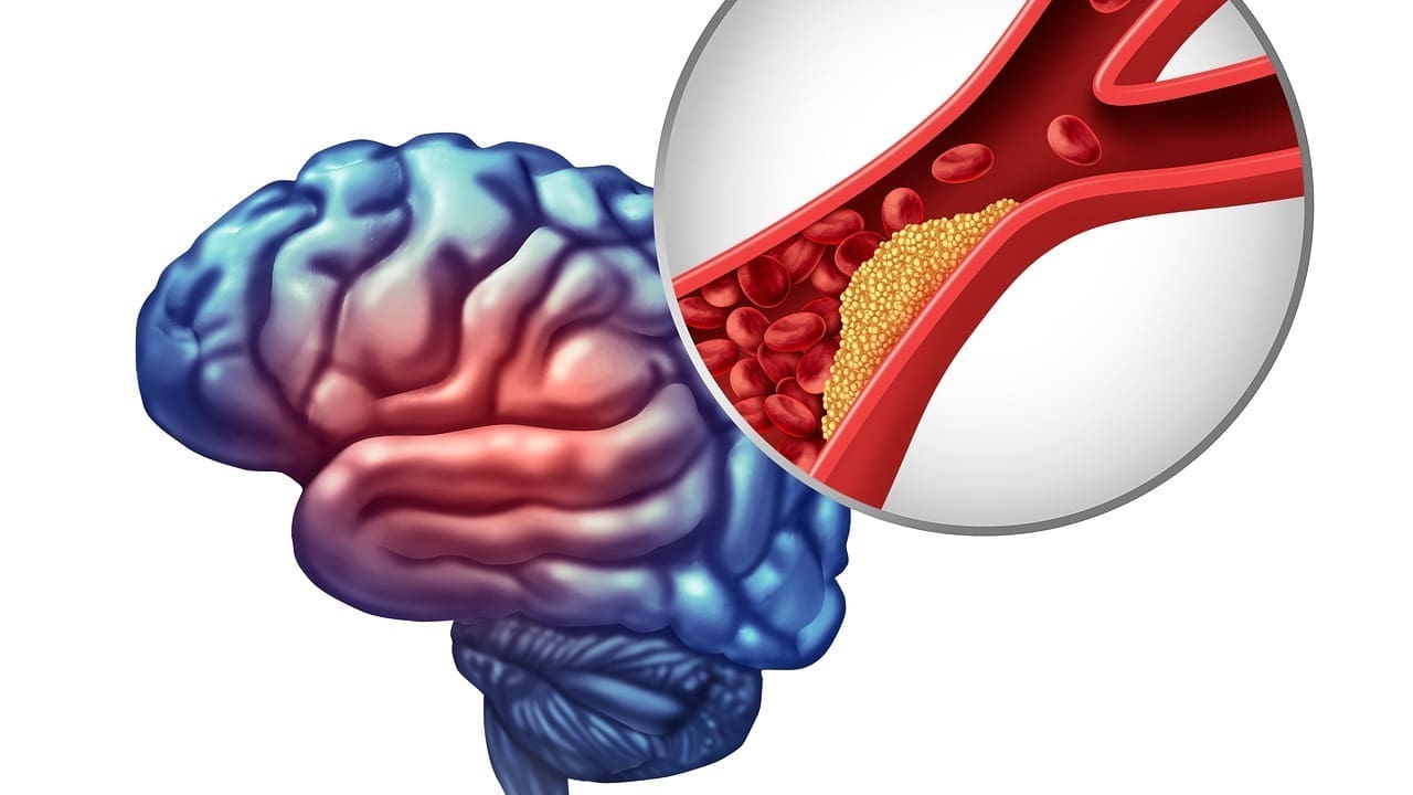 Fluid on the Brain in Adults: 7 Key Facts You Need to Know