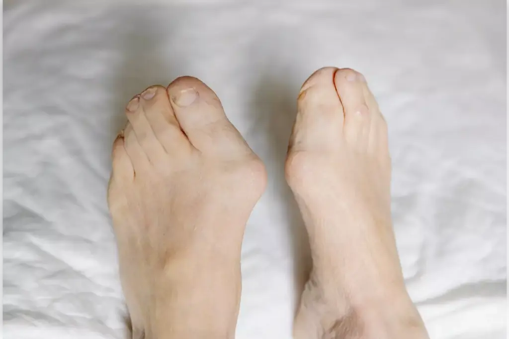 hallux valgus surgery recovery hallux valgus surgery recovery