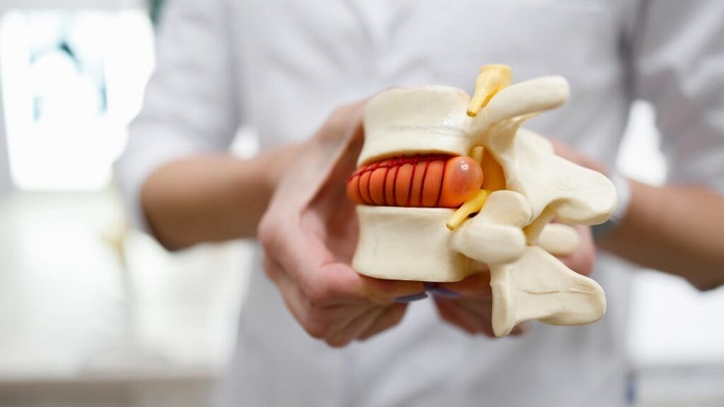 herniated disc diagram