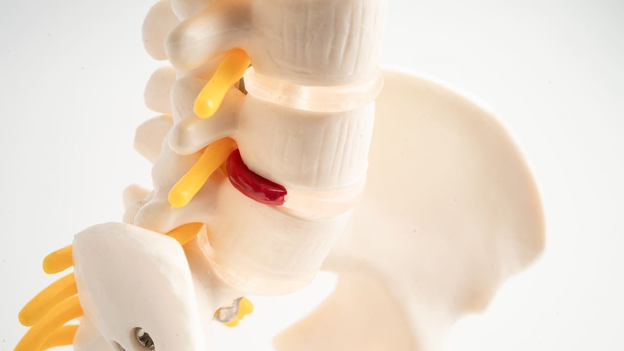 11 Herniated Disk Images: What Slipped, Ruptured, and Bulging Discs Look Like
