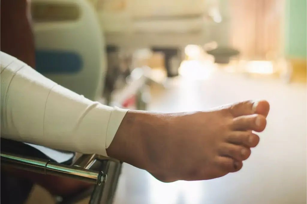 how painful is bunion surgery