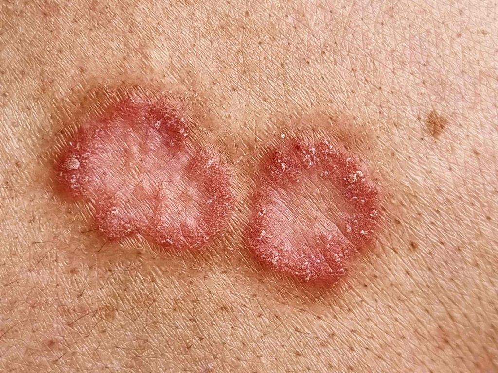 human skin afflicted with basal cell carcinoma