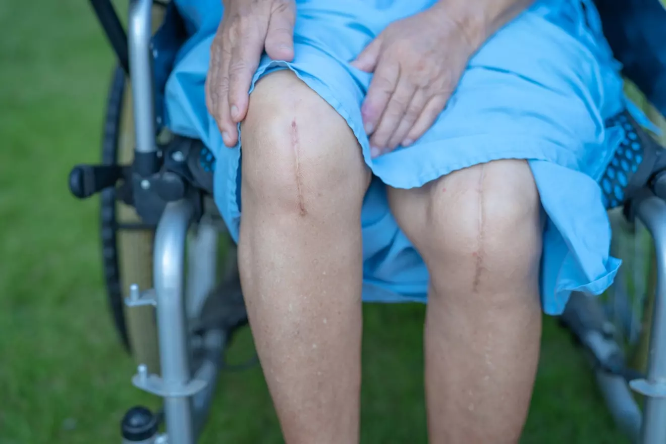 How Often to Ice After Knee Replacement: 7 Essential Recovery Tips