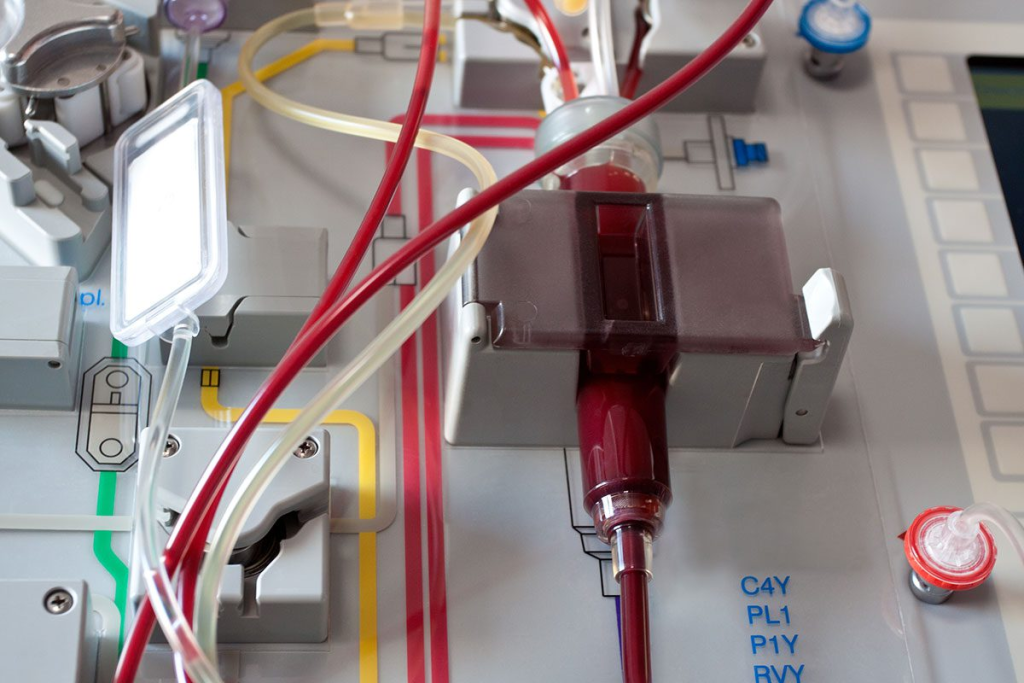 Eligibility: Who is Not a Candidate for stem cells Transplant?