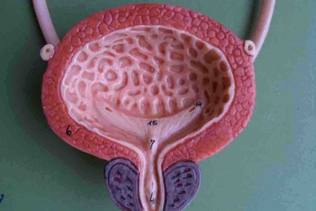 Hypotonic Neurogenic Bladder: Crucial