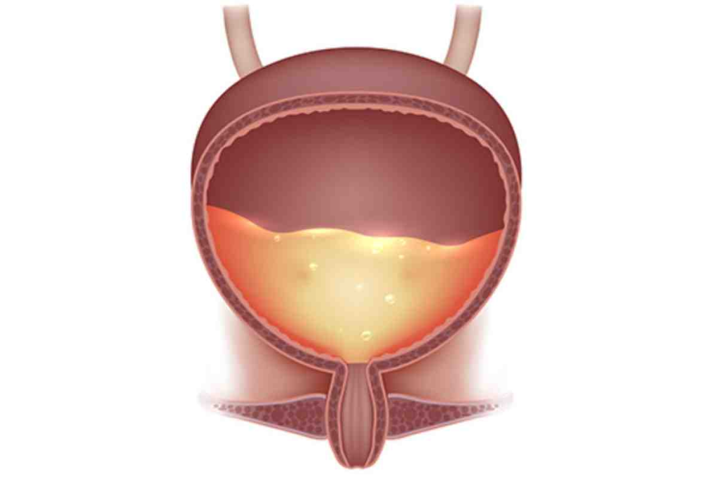 Neurogenic Bladder: Crucial 4 Types Explained