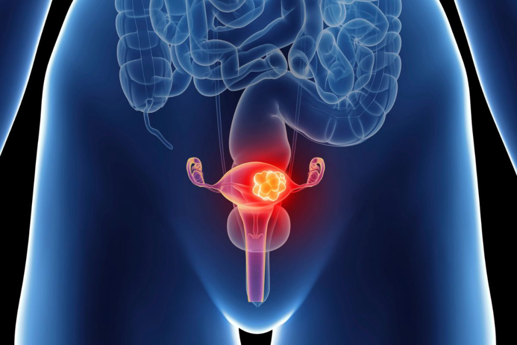 Neurogenic Bladder: Crucial 4 Types Explained