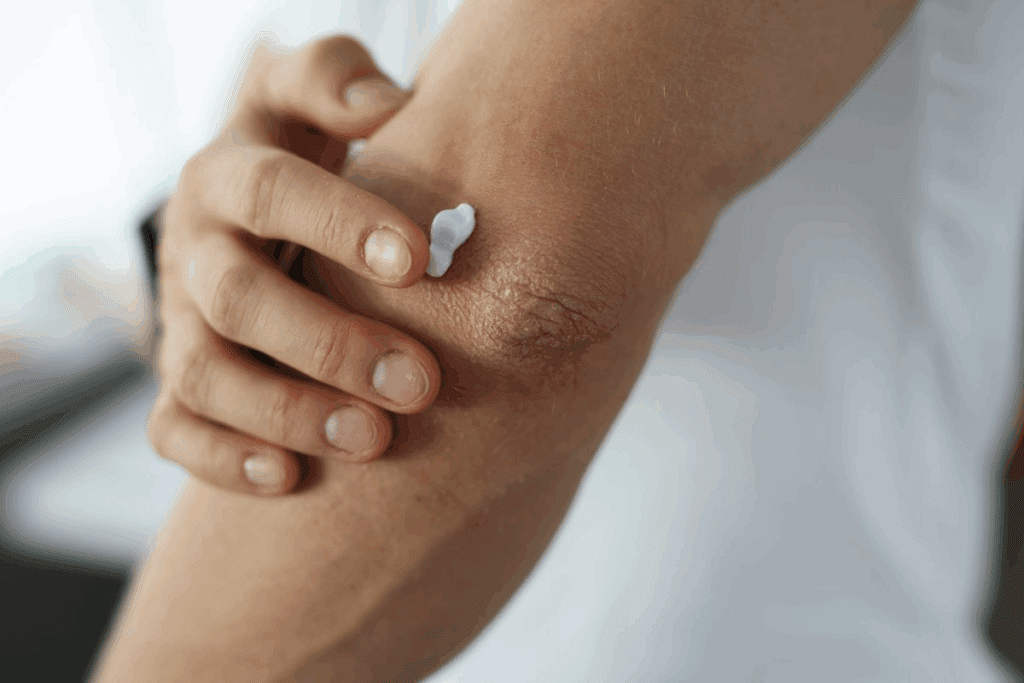Does Bursitis Cause Bruising Around the Joint?