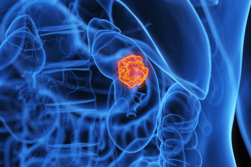 Treatment For Kidney Cancer Stage 1: 7 Best Options