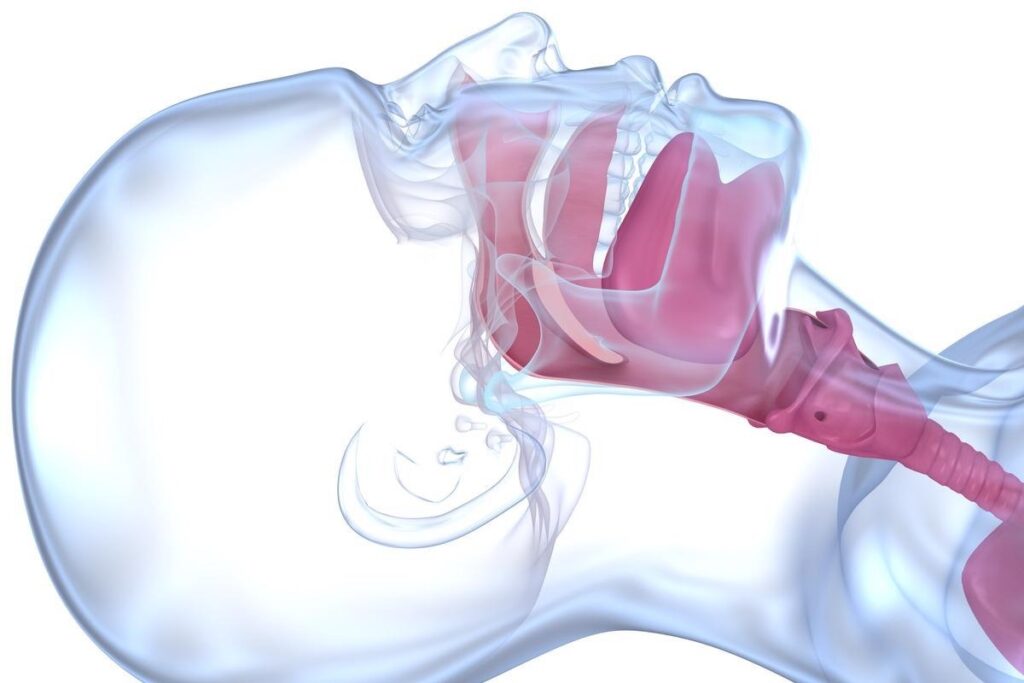 Stertor: The #1 Cause of Upper Airway Obstruction