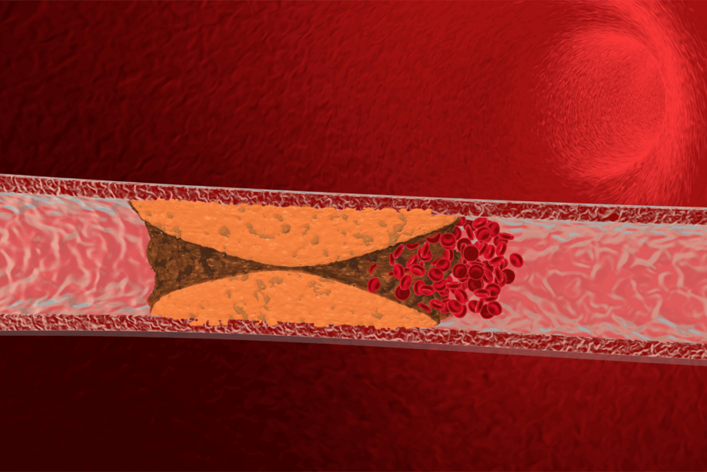 How Much Blockage Before Stent? The Critical Number