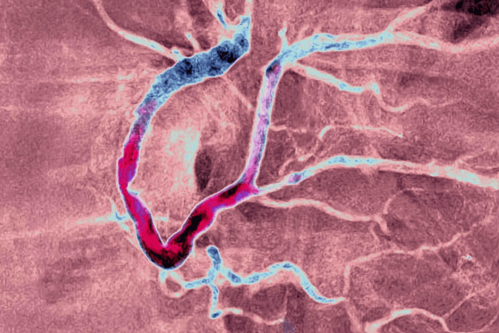 What Is Atherosclerosis? Key Differences Explained