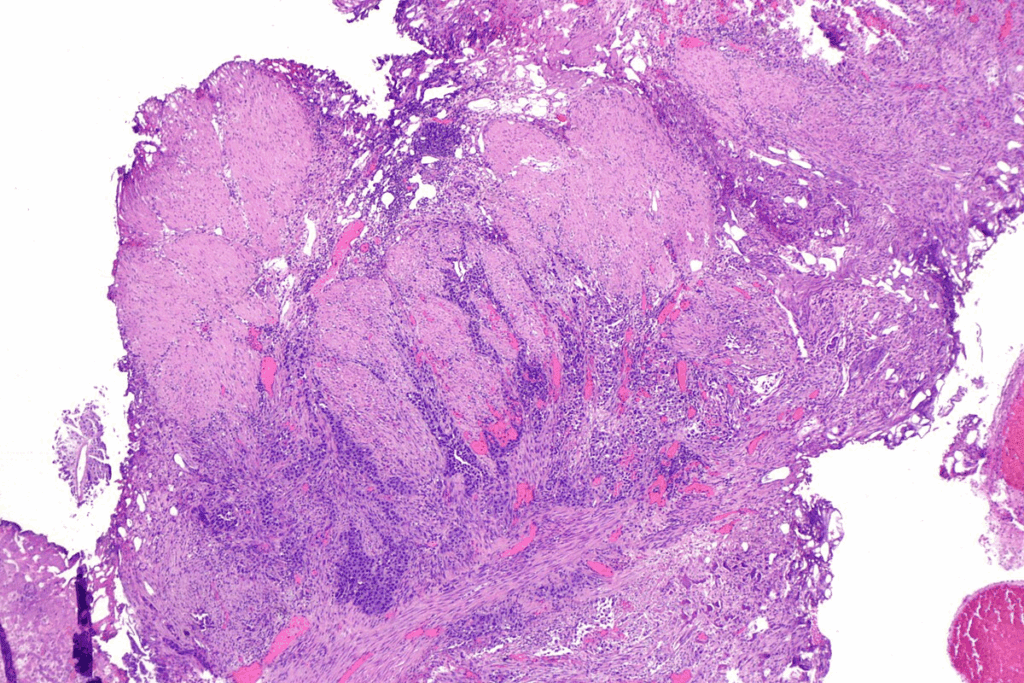 Bladder Polyp Biopsy: 7 Best Key Facts on Symptoms & Diagnosis