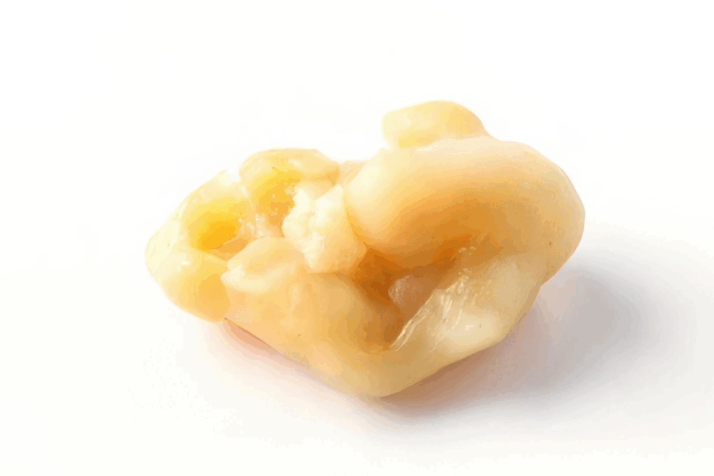 Quinsy Throat: Powerful Causes, Signs & Treatment 3 Quinsy Throat: Powerful Causes, Signs & Treatment