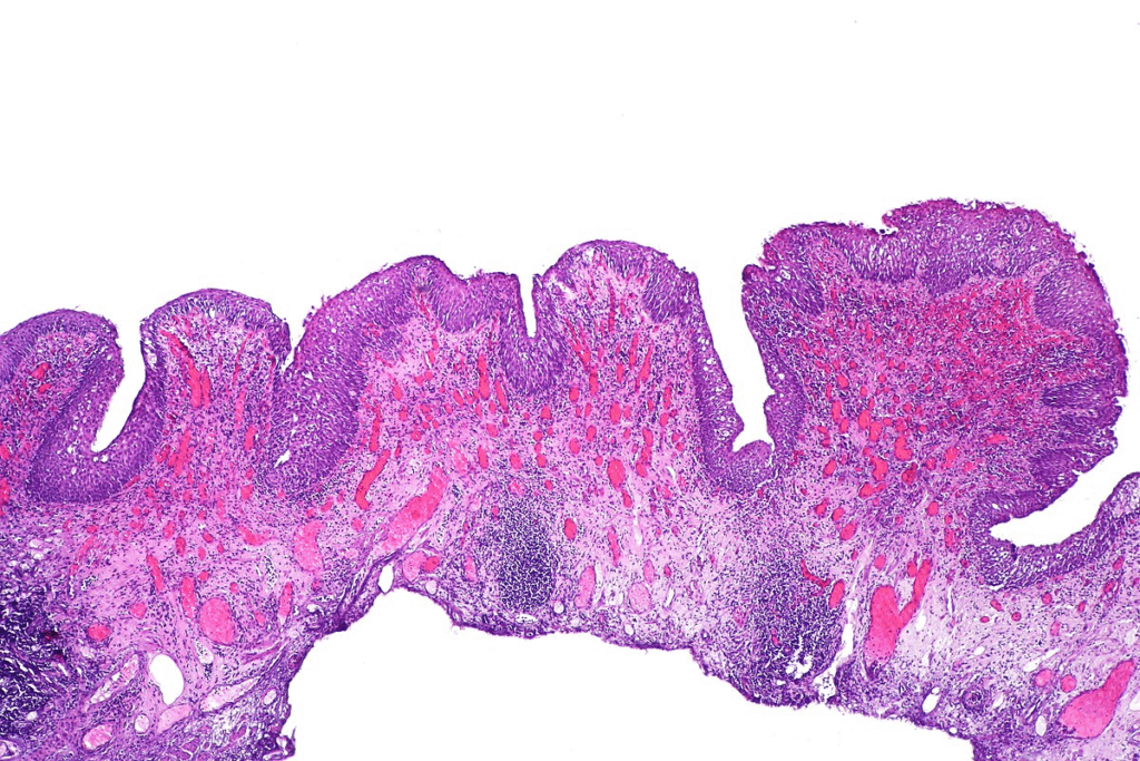 Stage 3 Bladder Cancer Prognosis: What to Expect