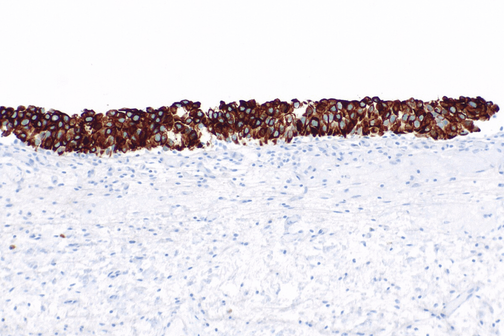 Urothelial Carcinoma in Situ: Pathology Guide