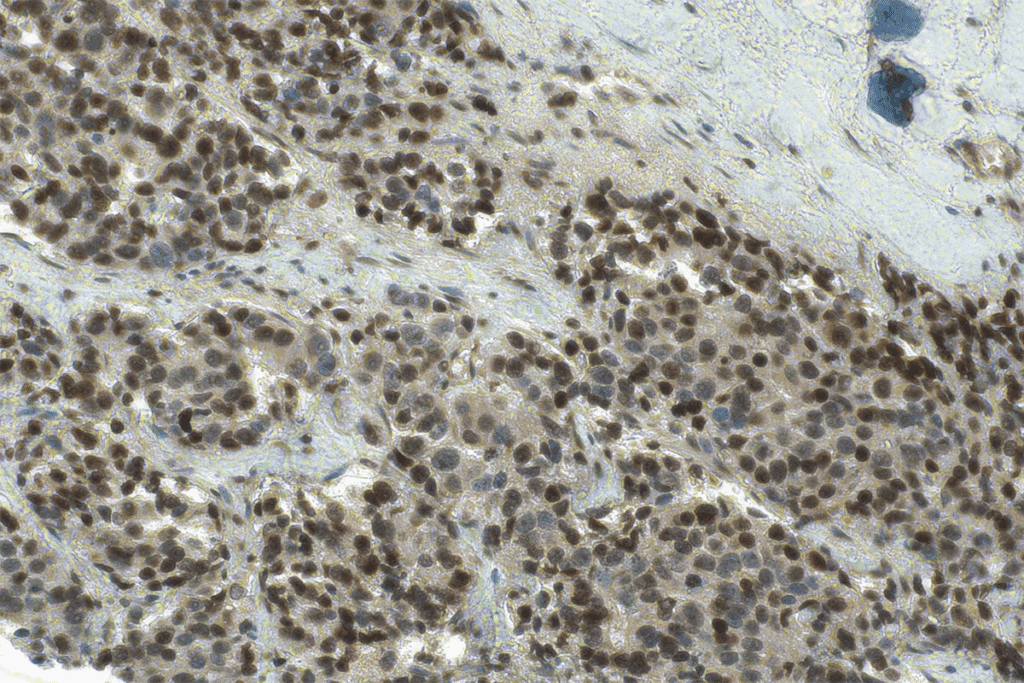 CIS Cancer: Definition and Key Facts