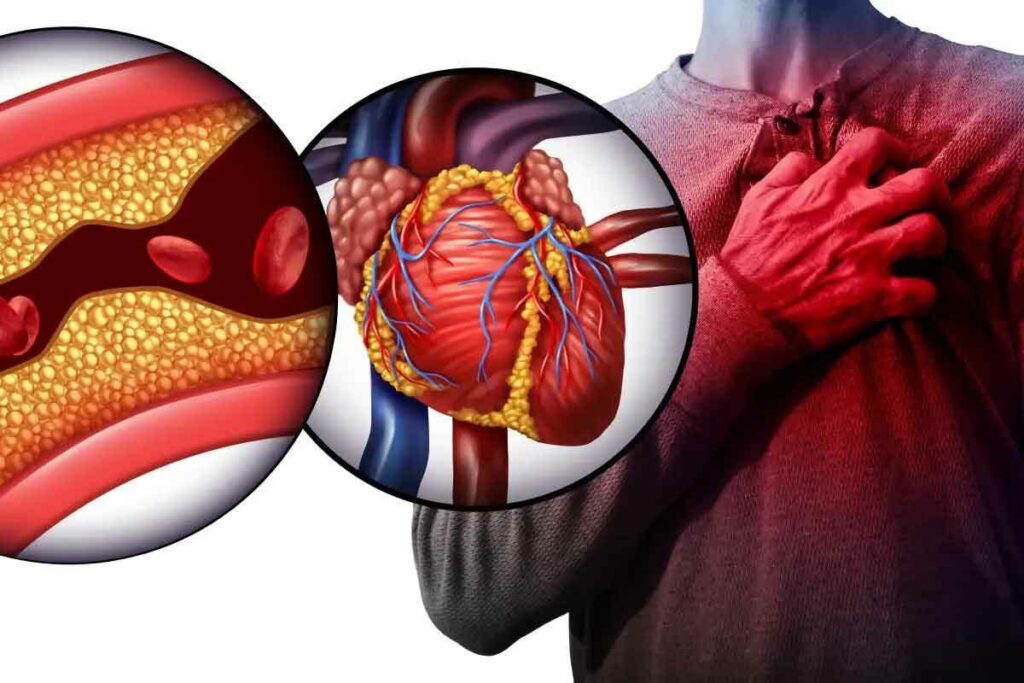 What Is Acute Coronary Artery Thrombus and How Does It Cause Heart Attacks?
