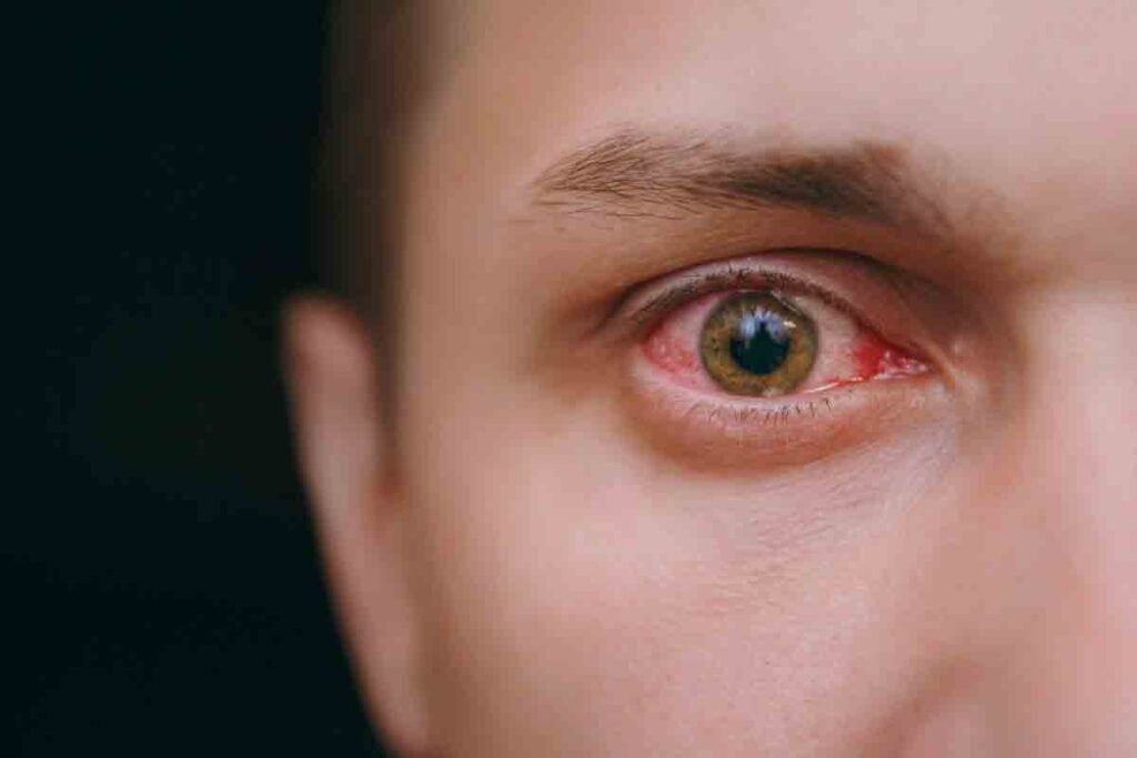 How Can You Check for Anemia in the Eyes And Does Low Iron Cause Blurry Vision?