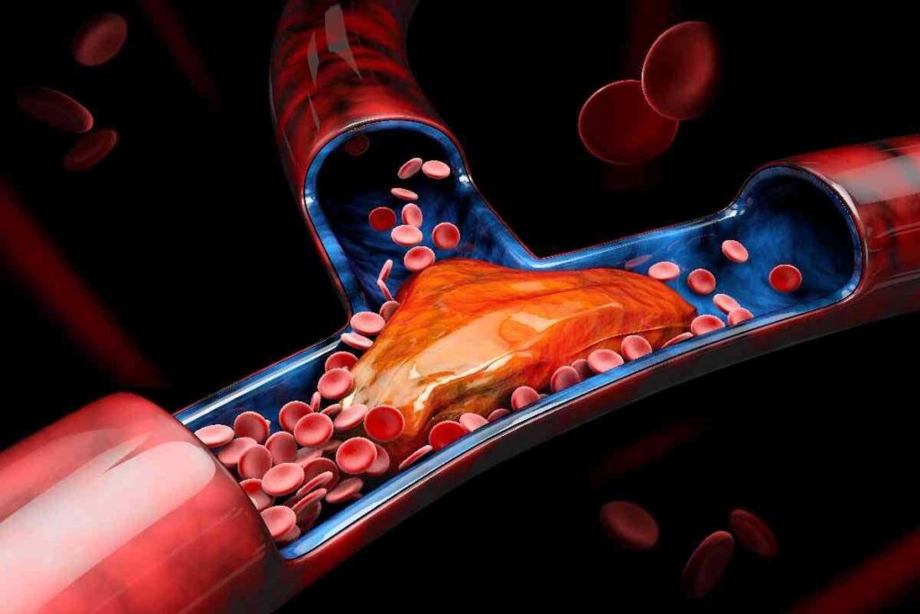 Define Thrombosis: 7 Key Facts About Blood Clots Blocking Vessels
