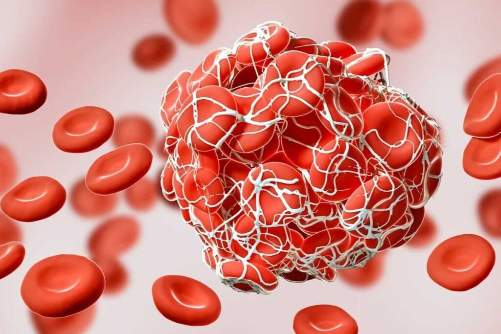 7 Key Facts About Acute Thrombosis: Symptoms, Treatment, and Differences