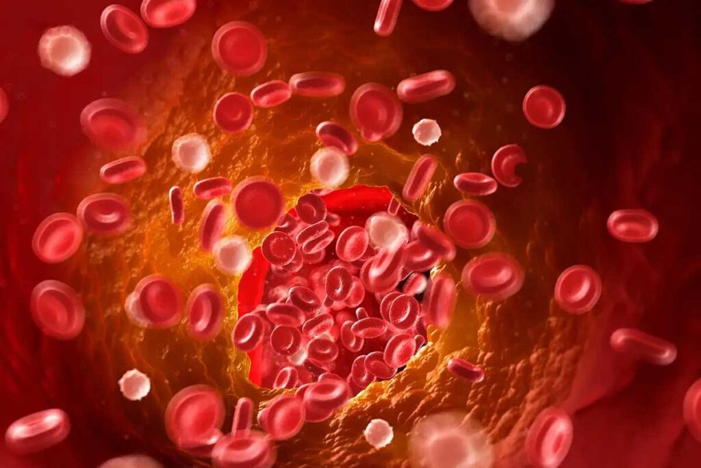 7 Key Facts About Acute Thrombosis: Symptoms, Treatment, and Differences