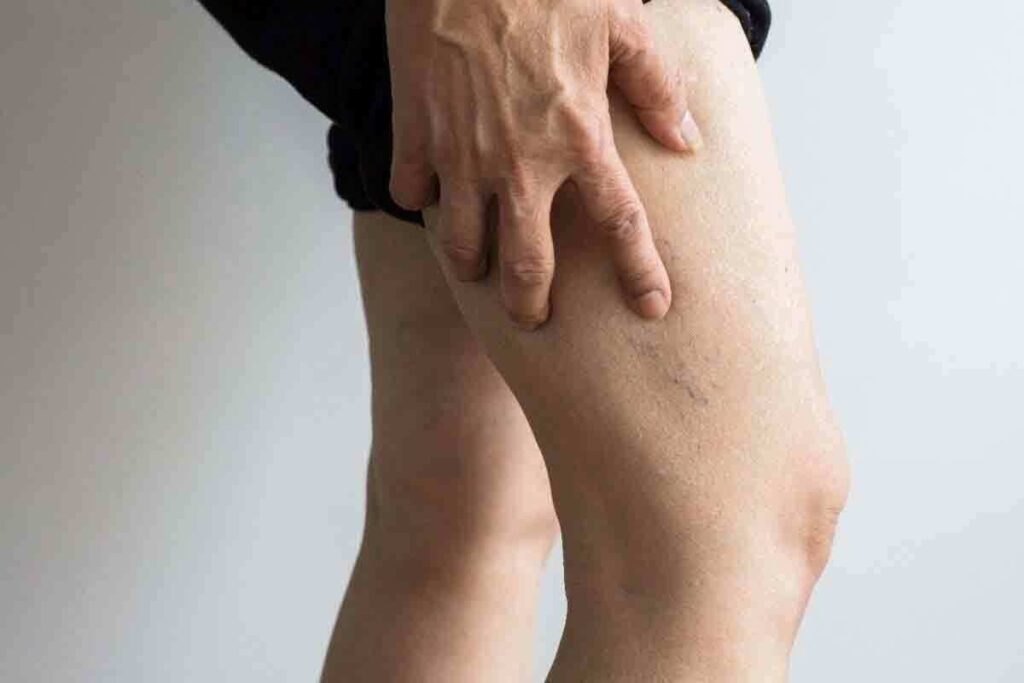 What Doctor to See For Blood Clots in Legs and How Is DVT Recovery Managed?