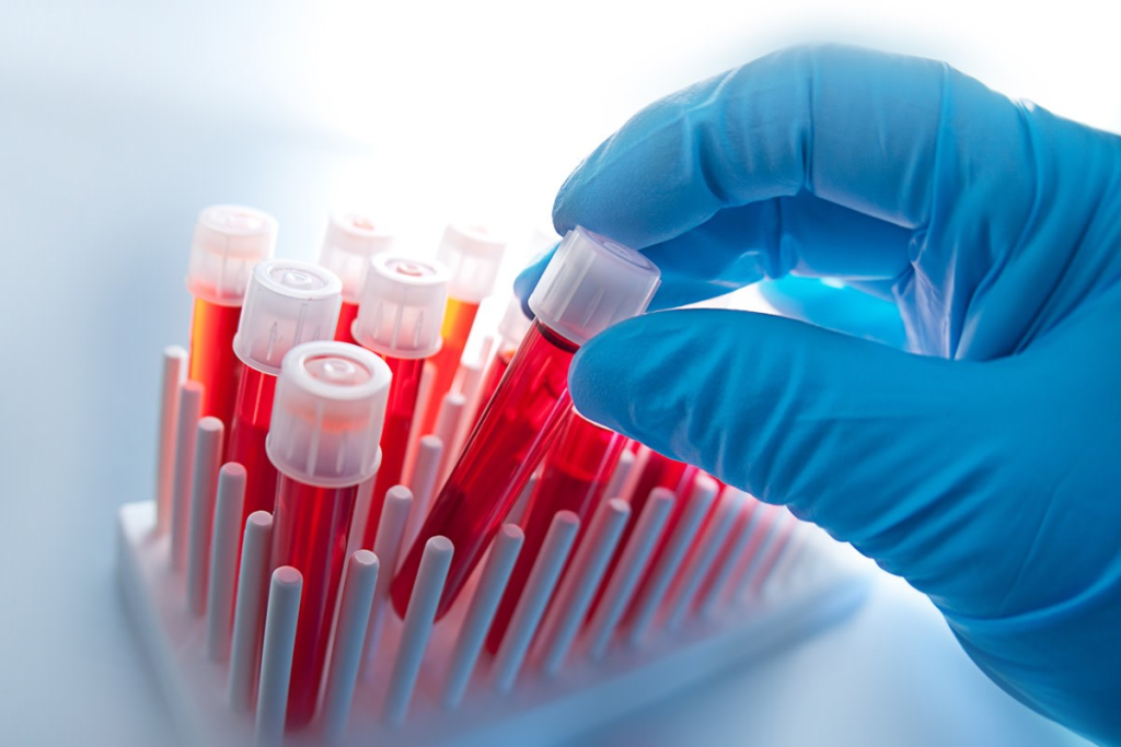 RDW Blood Analysis: An Ultimate, Amazing Guide