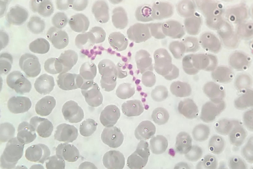 Thrombocytopenia Emergency Criteria: Dangerous Lows