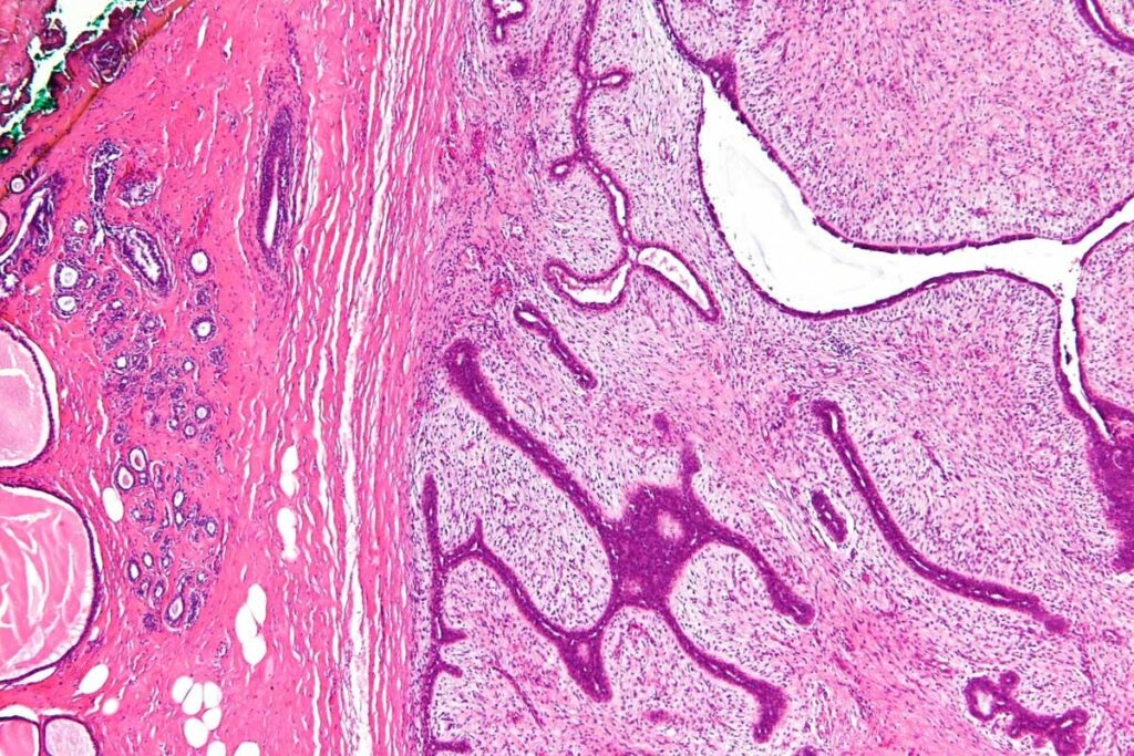 Muscle Tissue Tumor Medical Term: Are Sarcomas Always Malignant?